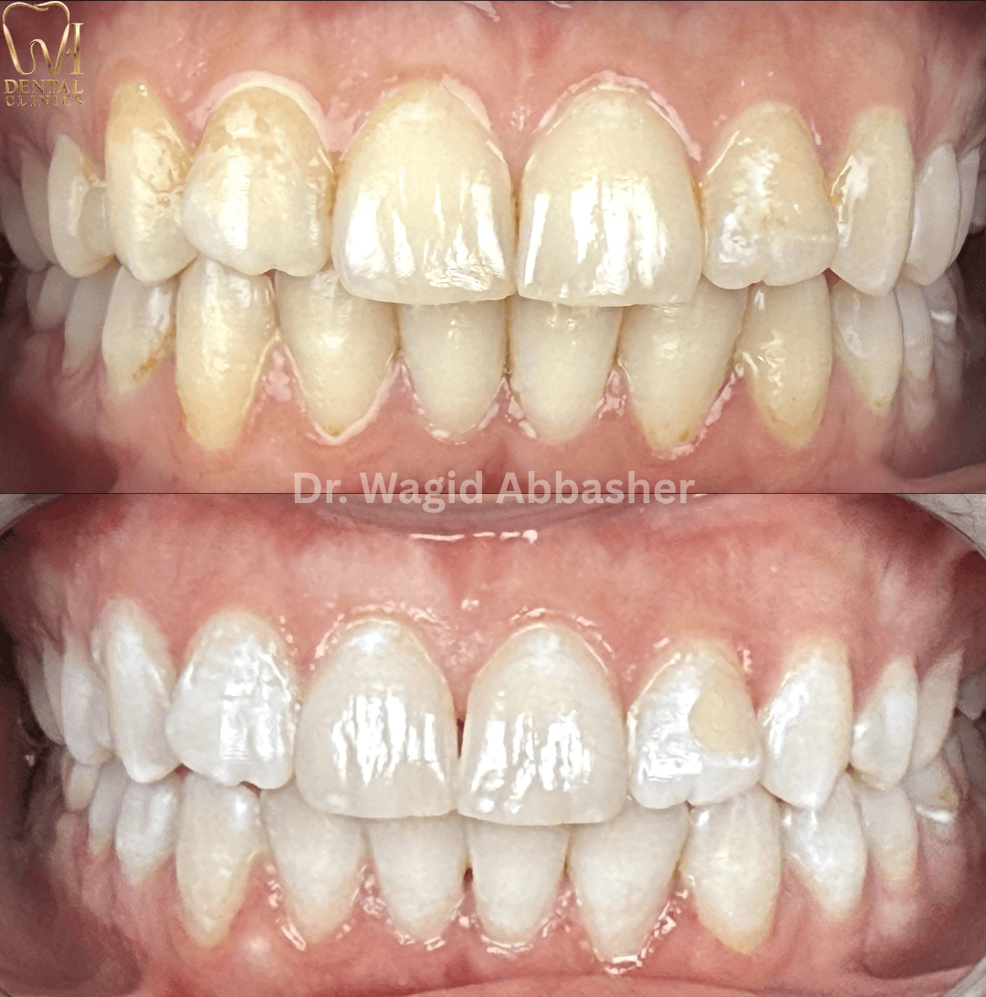 Clear Aligners before