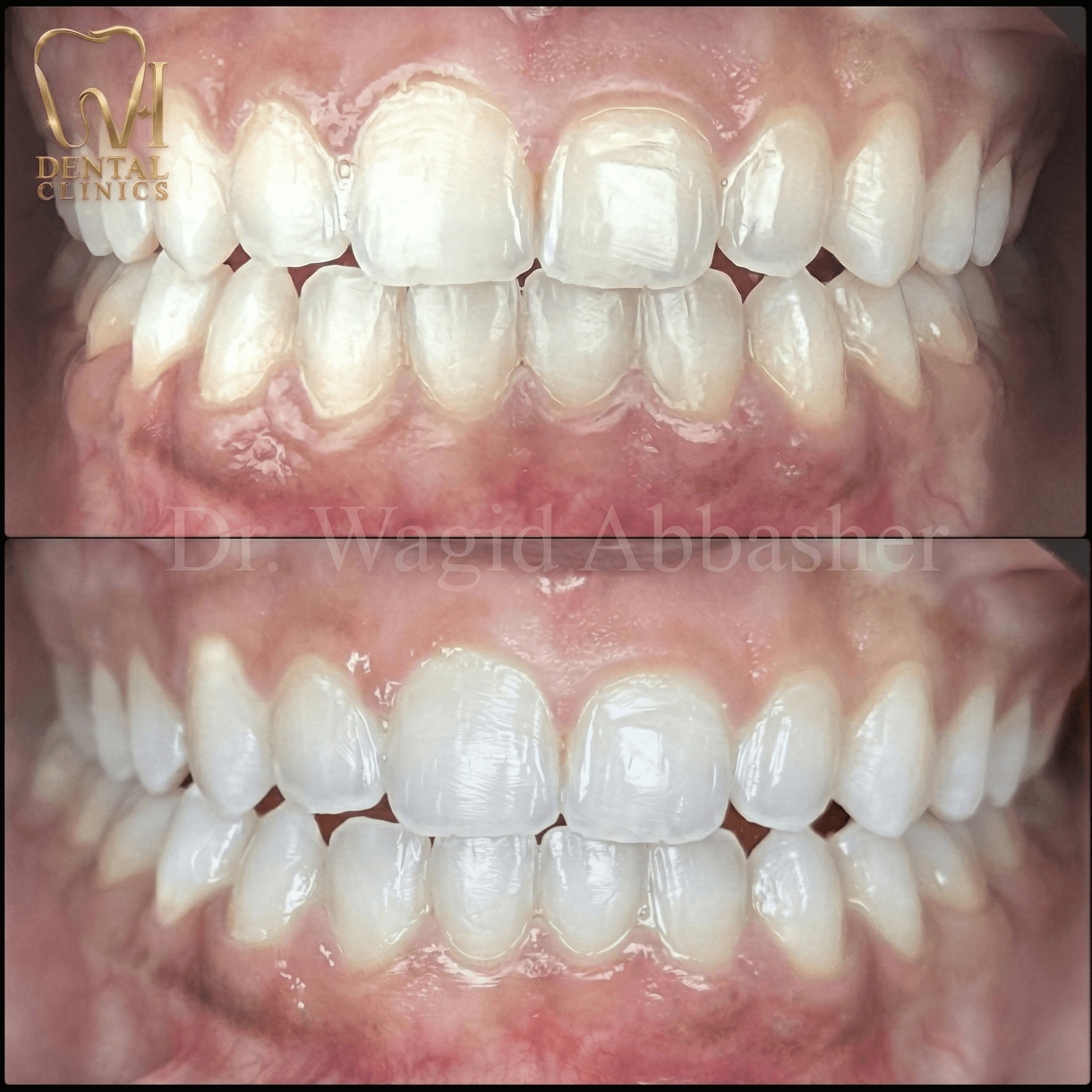 Full Smile Redesign before