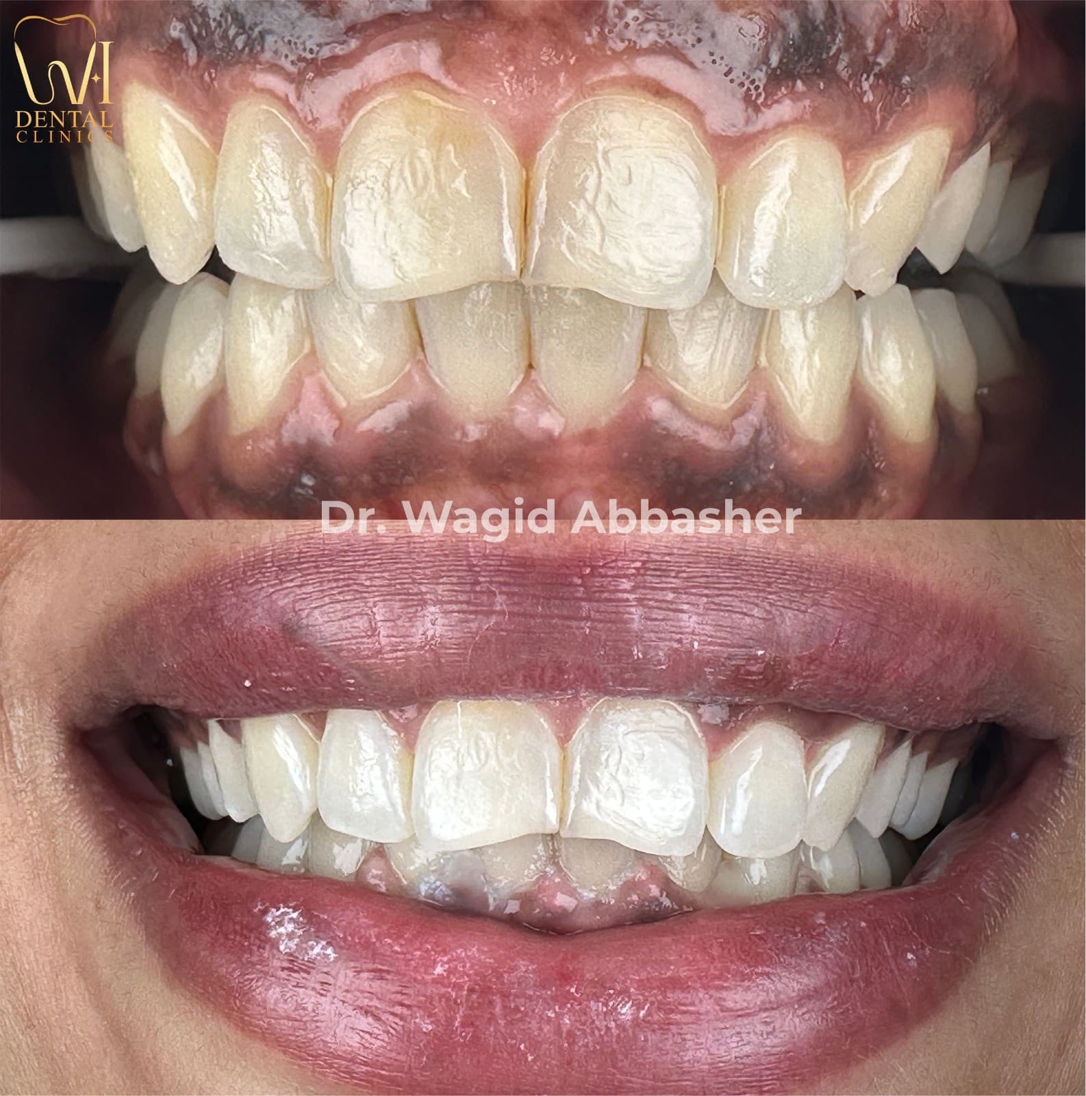Aesthetic Restoration before