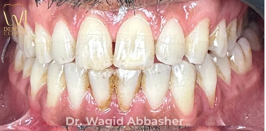 Teeth Cleaning before