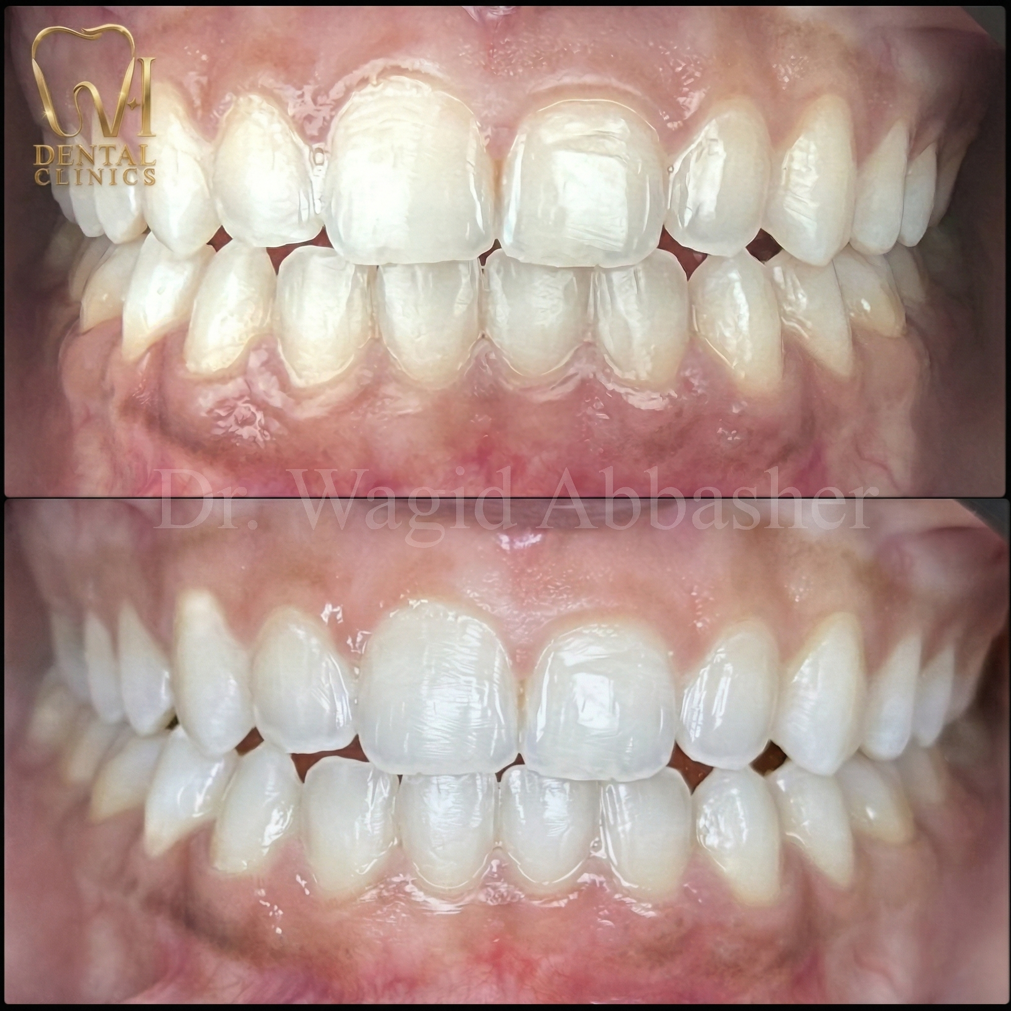 Full Smile Redesign before