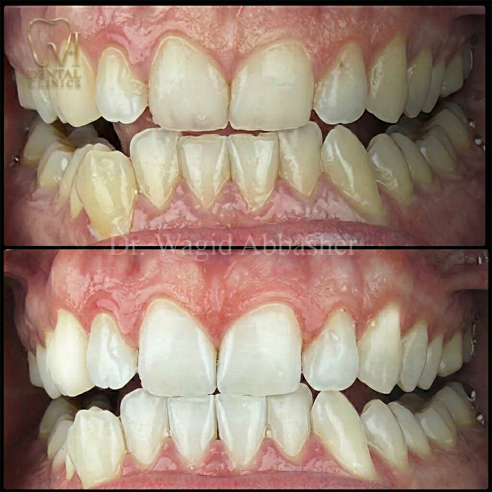Teeth Whitening before