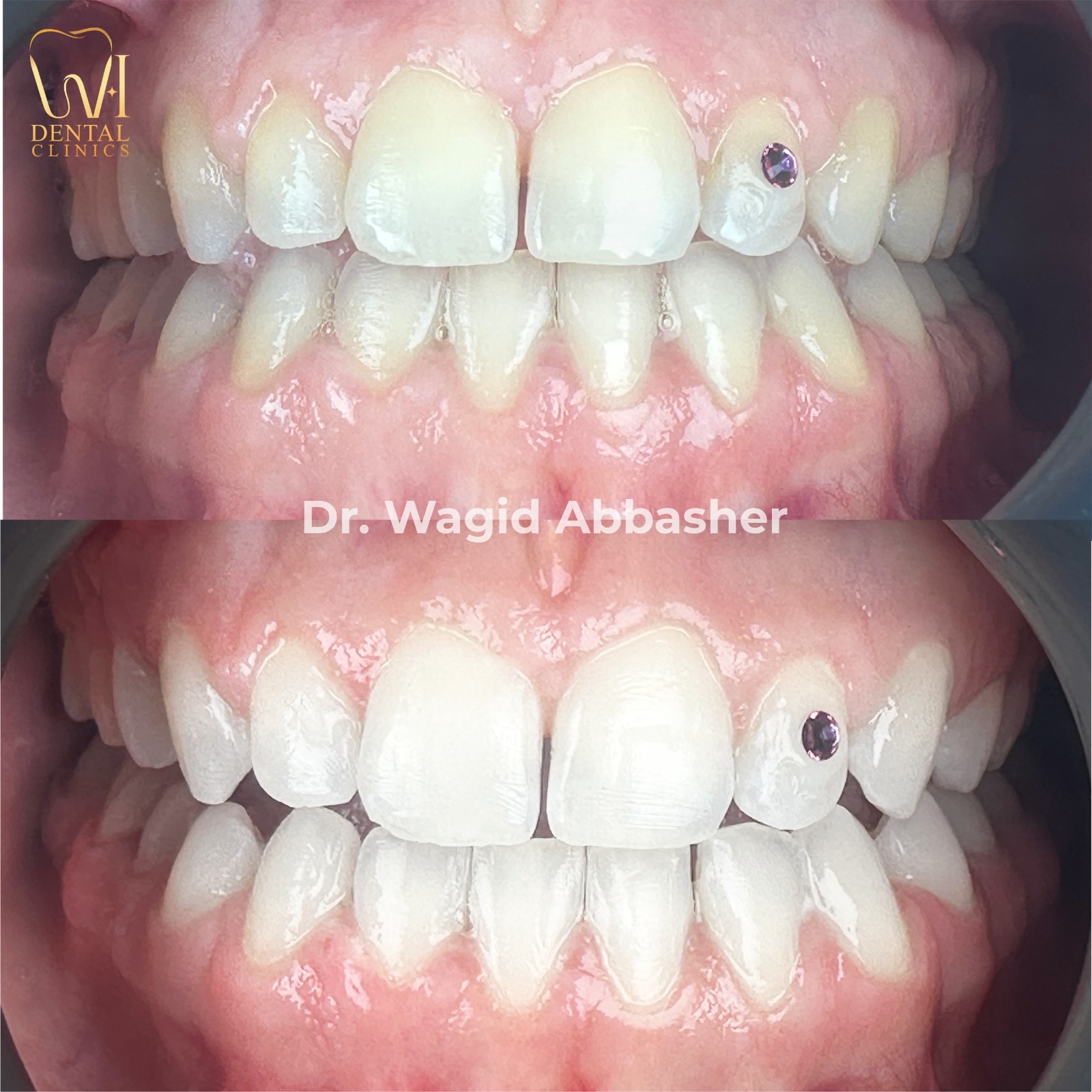 Smile Correction before